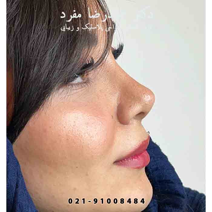 بینی عروسکی یا همون "Barbie nose"