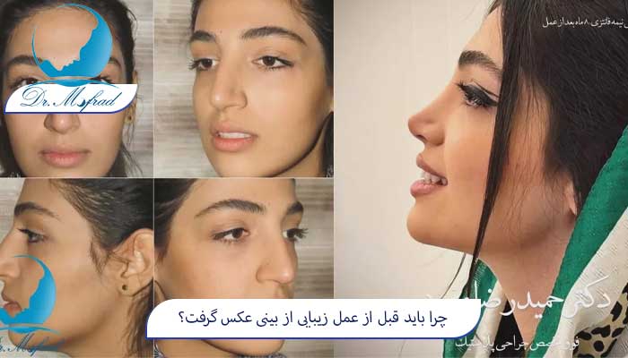 چرا باید قبل از عمل زیبایی از بینی عکس گرفت؟