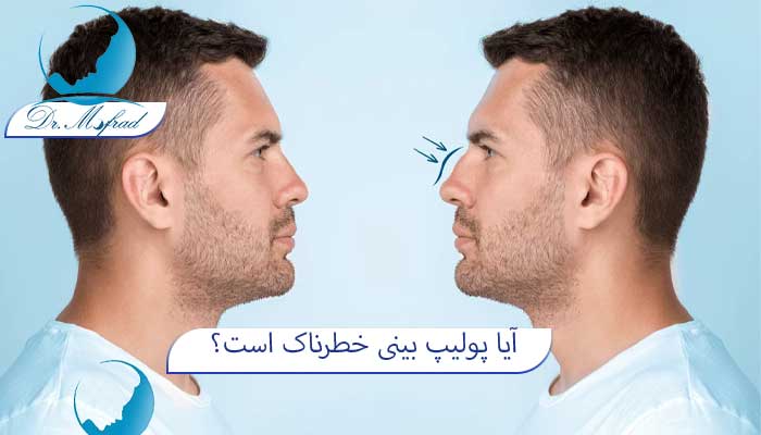 آیا پولیپ بینی خطرناکه