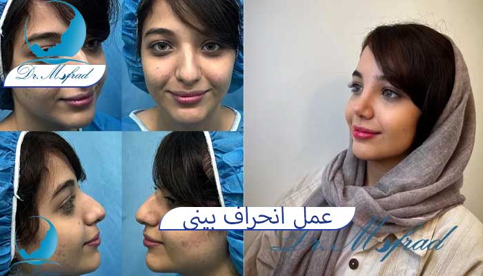 عکس قبل و بعد جراحی بینی 