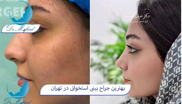 بهترین جراح بینی استخوانی در تهران