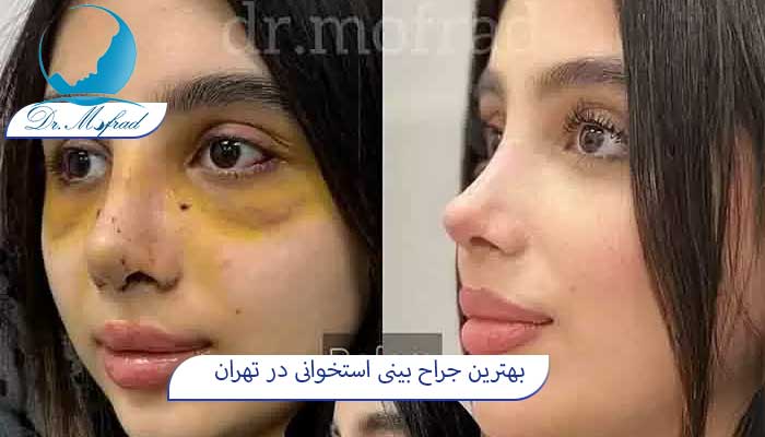 بهترین دکتر بینی استخوانی در تهران