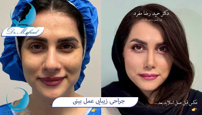 جراحی بینی گوشتی در تهران
