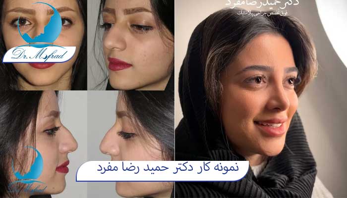 رفع قوز بینی دکتر مفرد