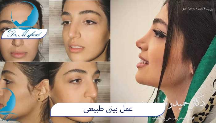 عمل بینی نچرال