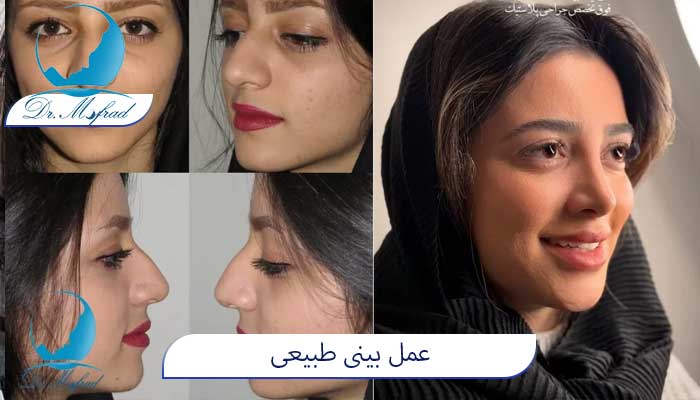 عمل بینی طبیعی