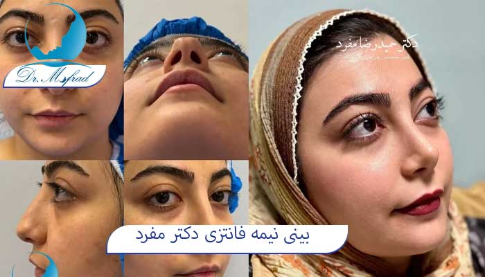 عمل بینی نیمه فانتزی