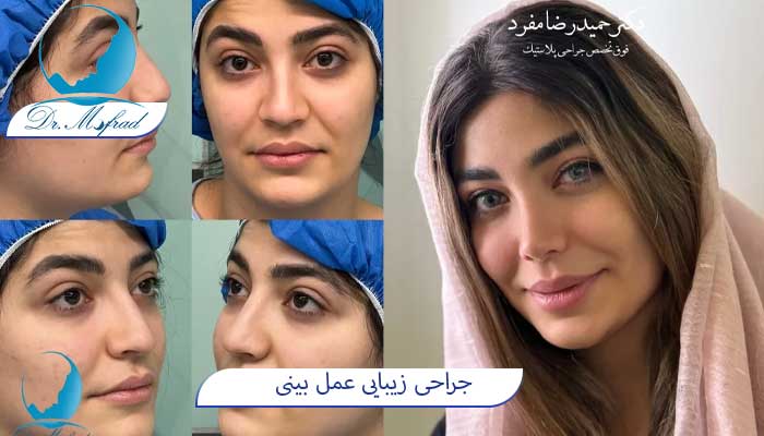 عمل بینی استخوانی دکتر مفرد