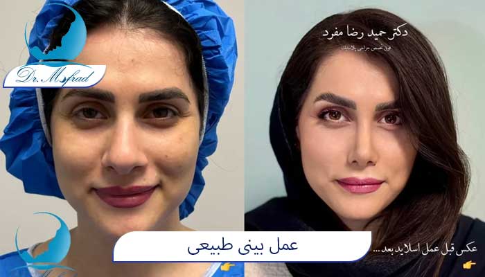 هزینه عمل طبیعی 