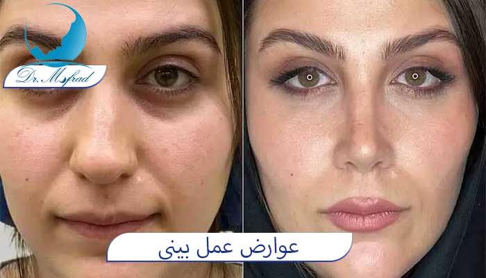 علت بروز عوارض عمل بینی