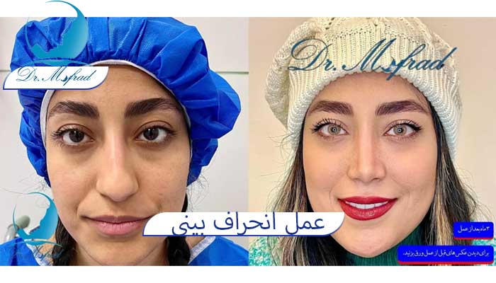 عکس قبل و بعد بینی دکتر مفرد