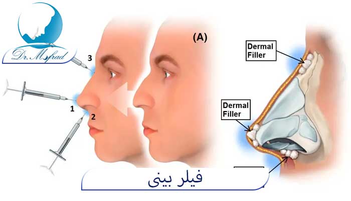 فبلر بینی چیست؟