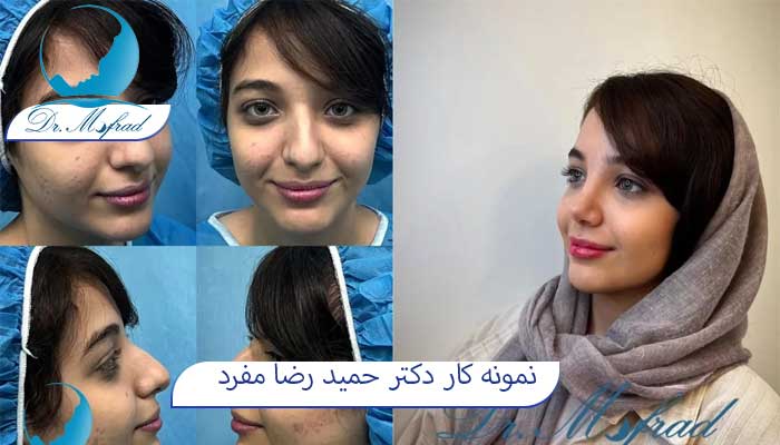 عمل رفع قوز بینی توسط دکتر مفرد