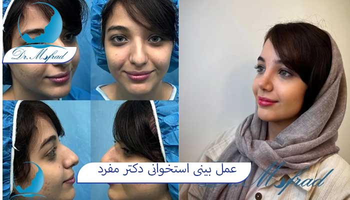 نمونه کار بینی استخوانی دکتر مفرد