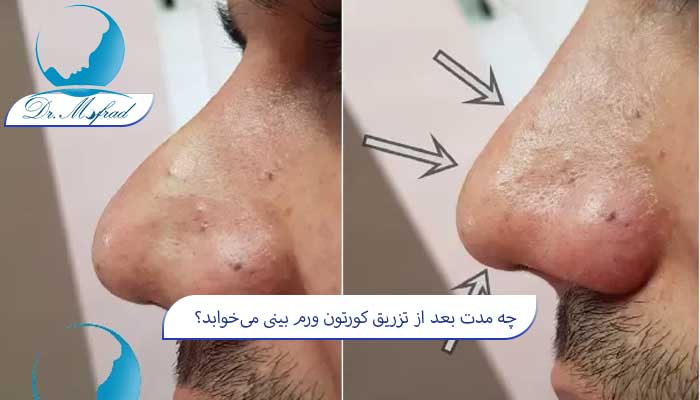 چه افرادی نیاز به تزریق کورتون پس از عمل بینی دارند؟