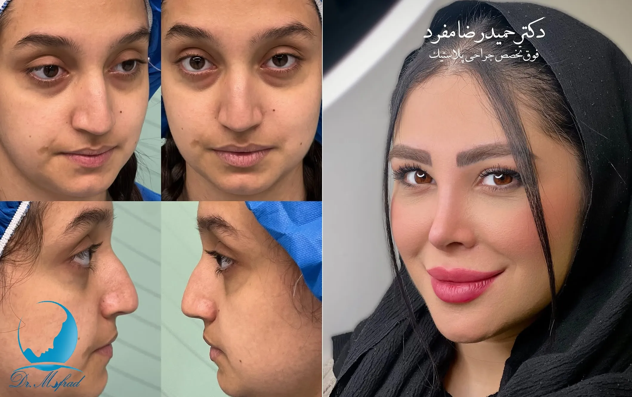 عکس قبل و بعد عمل