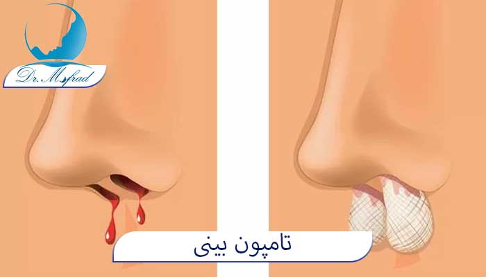 تامپون بینی