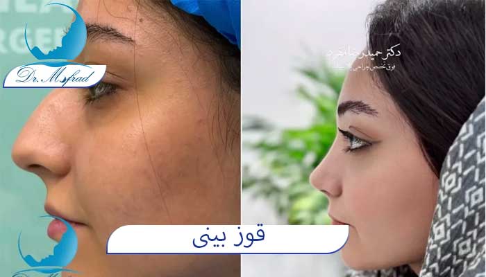 قوز بینی