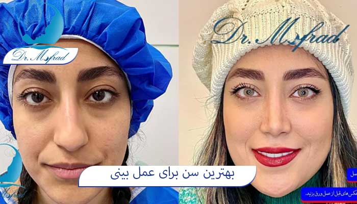 چه سنی برای عمل بینی مناسب است؟