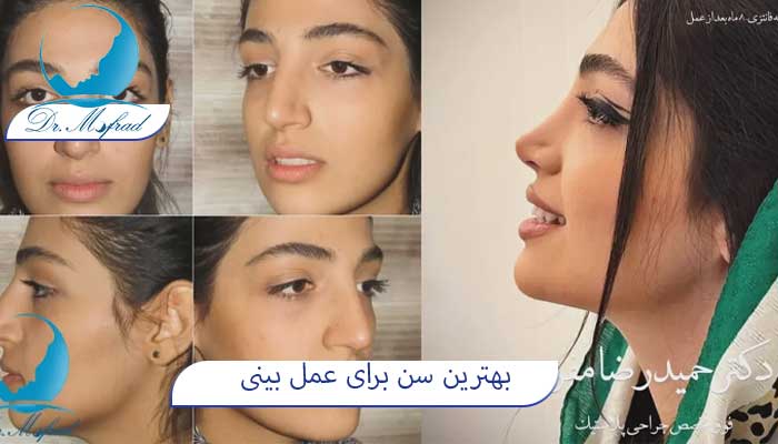 چه سنی میتونم بینی امو عمل کنم؟