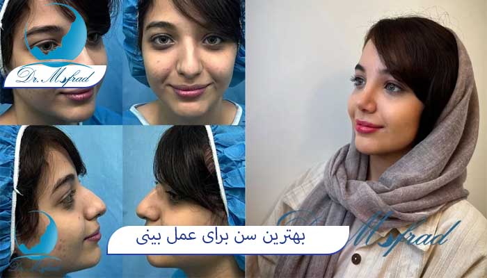 بهترین سن برای جراح بینی 