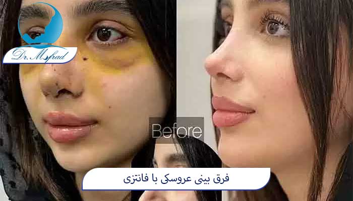 فرم نوک بینی در مدل عروسکی و فانتزی
