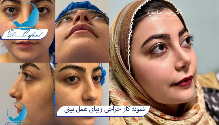 تایم جراحی بینی چقد طول میکشد؟