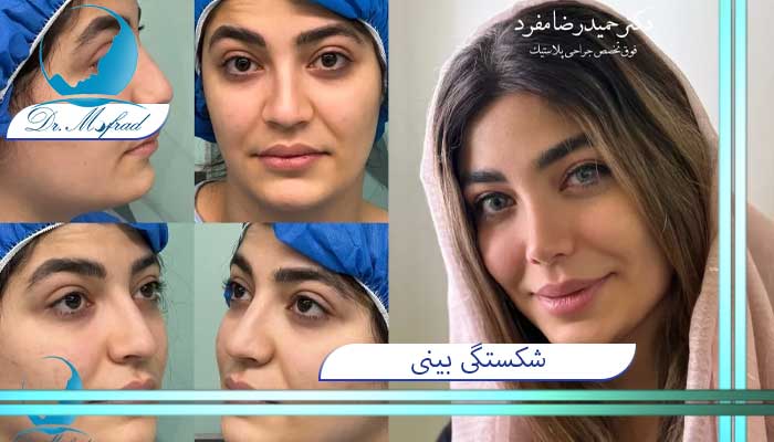 علائم شکستگی غضروف بینی