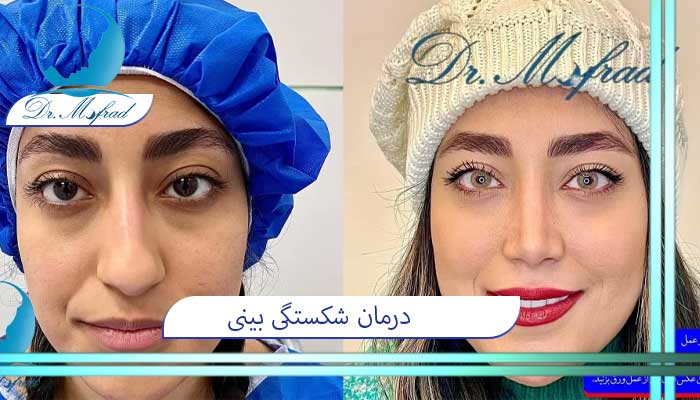 علائم شکستگی بینی در اثر ضربه چیست؟
