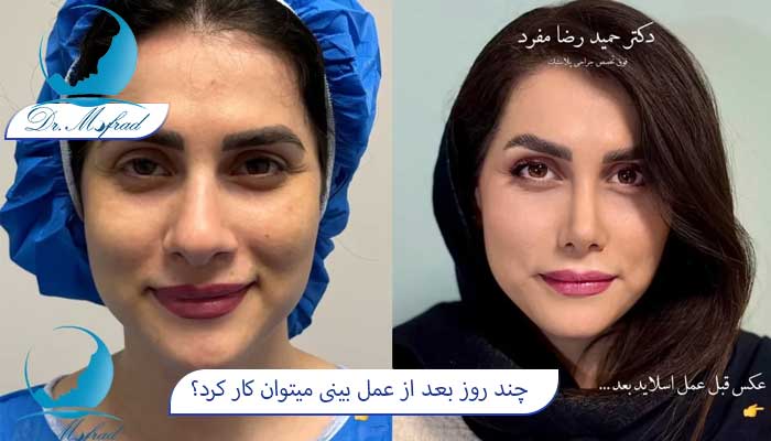 چند روز بعد از عمل بینی میتوان به سرکار برگشت؟
