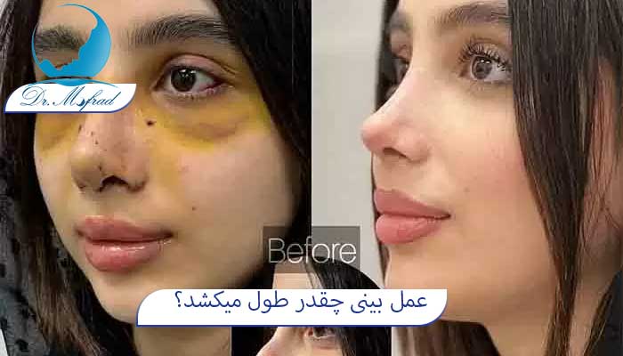 مدت زمان عمل بینی