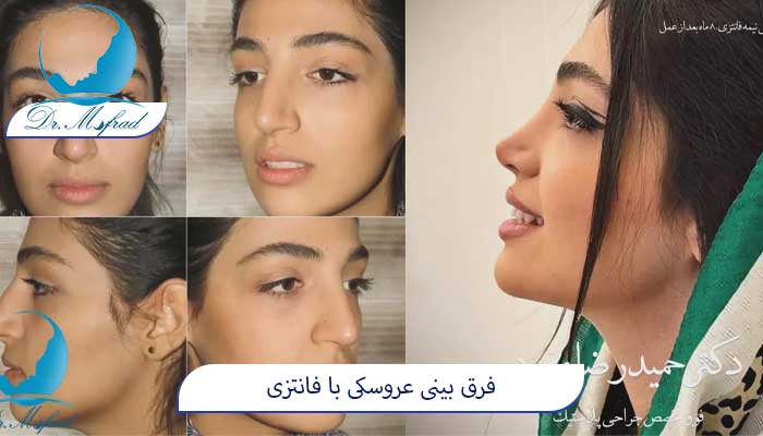 کدام مدل بینی طبیعی‌تر به نظر می‌رسد؟