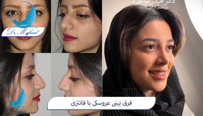 انواع مدل‌های بینی فانتزی (عروسکی)