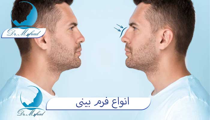 معرفی انواع فرم بینی