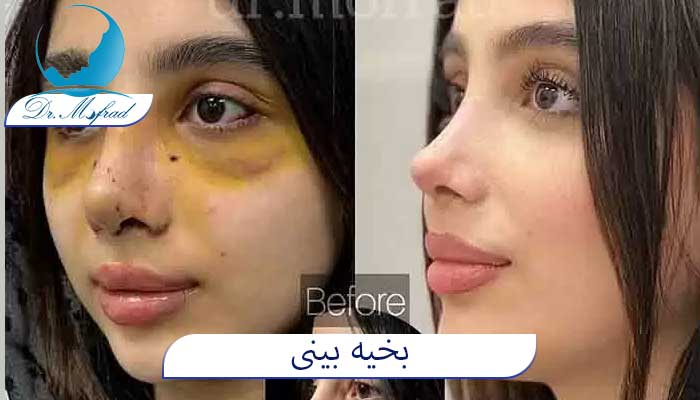 آیا کشیدن بخیه بینی درد دارد؟