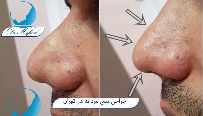 جراحی بینی زیبایی مردانه