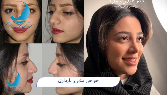 جراحی بینی و بارداری مناسب است؟