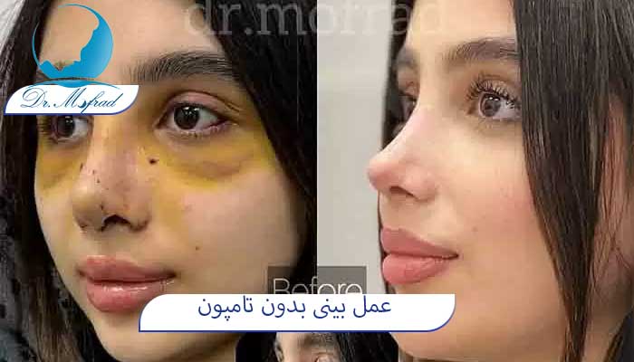 عمل بینی بدون تامپون دکتر مفرد