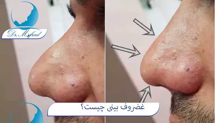 غضروف بینی چیست؟