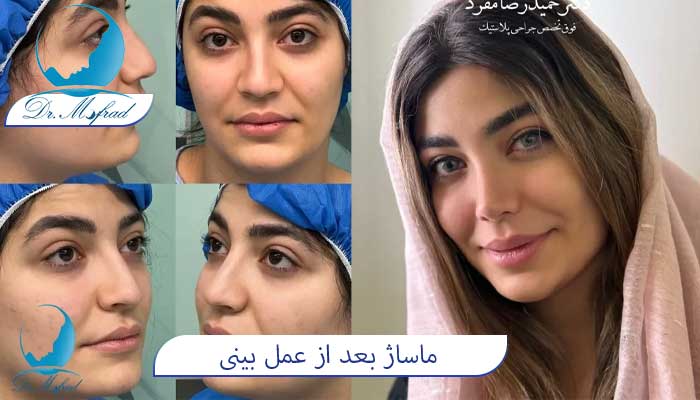 ماساژ بینی بعد از عمل چه مدت باید ادامه یابد؟