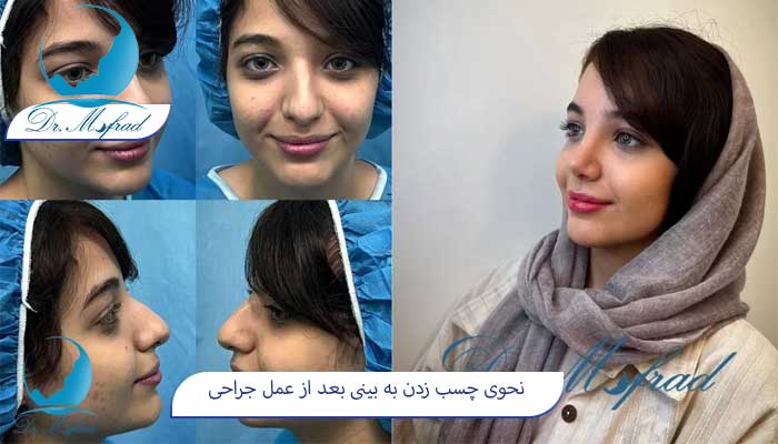 عوارض زیاد چسب زدن بینی بعد از عمل