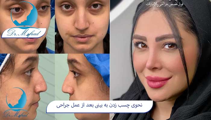 اشتباهات رایج در چسب زدن بینی