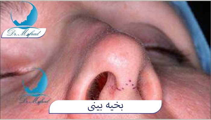 بخیه عمل بینی