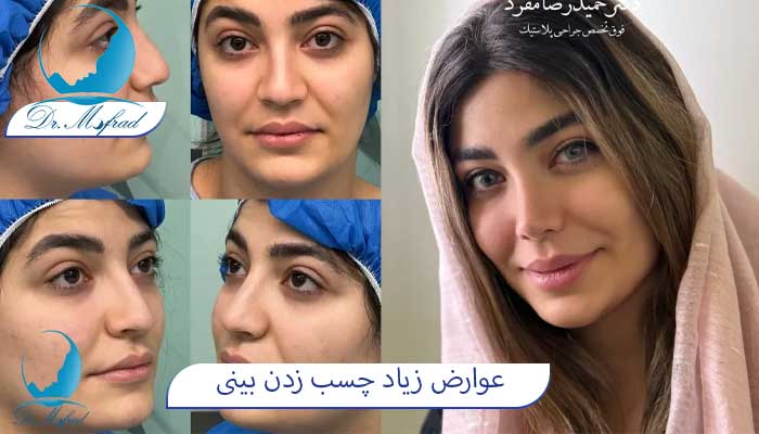 آیا می‌توان با چسب بینی به حمام رفت؟