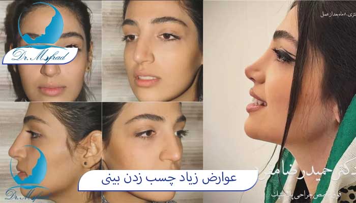 عوارض سفت زدن چسب بینی