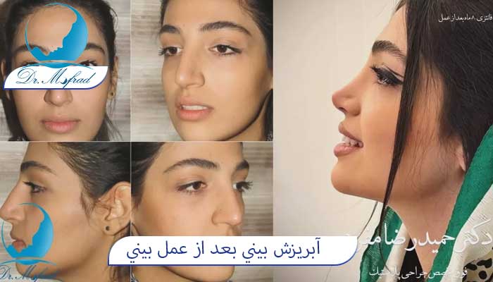 آبريزش بيني بعد از عمل بيني