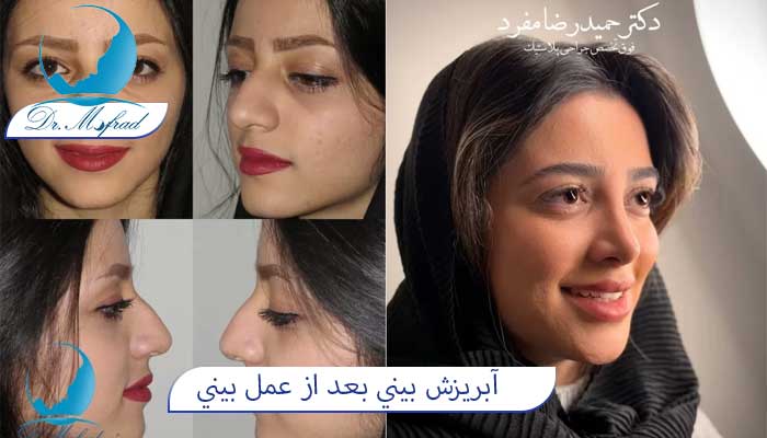 چه مدت بعد از عمل بینی آبریزش بینی ادامه دارد؟