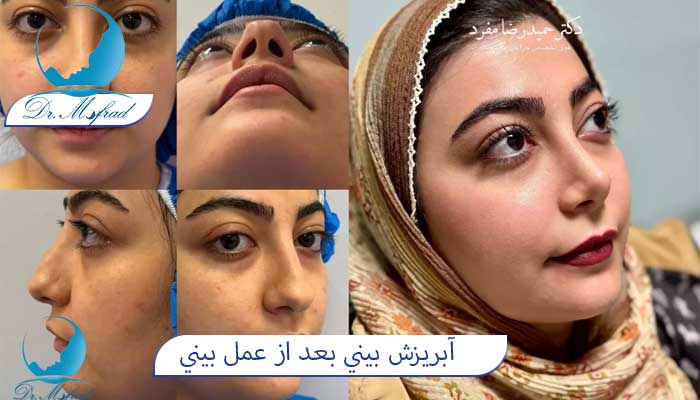 آبريزش بيني بعد از عمل بيني