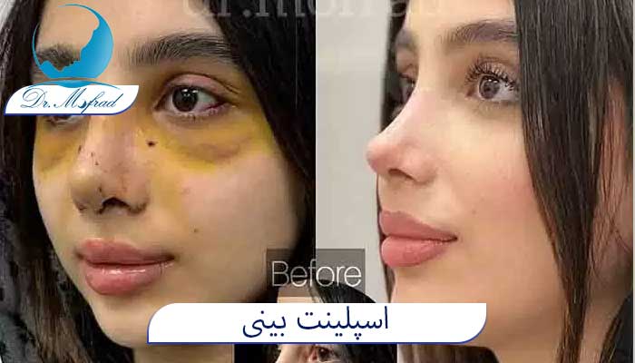 اسپلینت بینی چیست؟
