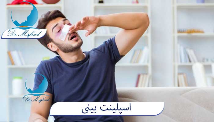 اسپلینت بینی